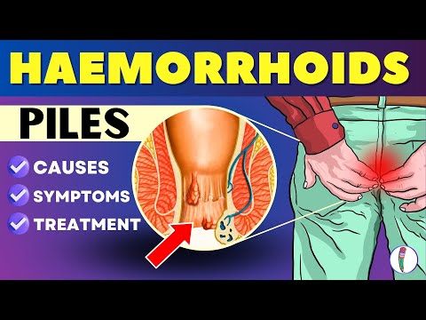 Hemorrhoids (Piles)   Symptoms, Causes, Treatment | Piles problem treatment  | Hemorrhoids symptoms