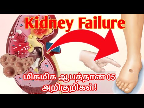 kidney pain location on body in tamil | kidney failure symptoms in tamil | kidney failure tamil