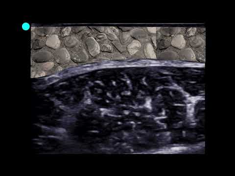 POCUS -  Soft Tissue Ultrasound -  Cobblestoning