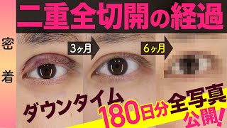 【二重整形】埋没二重から全切開二重に！半年分のダウンタイム・経過を全公開＊密着＊