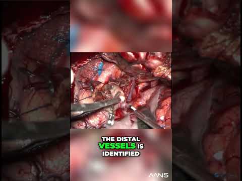 Inside Brain Surgery - Clipping Aneurysms Like a Pro