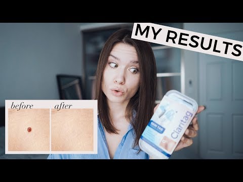 HOW TO REMOVE SKIN TAGS AT HOME FAST | Does Claritag Work? My Honest Review