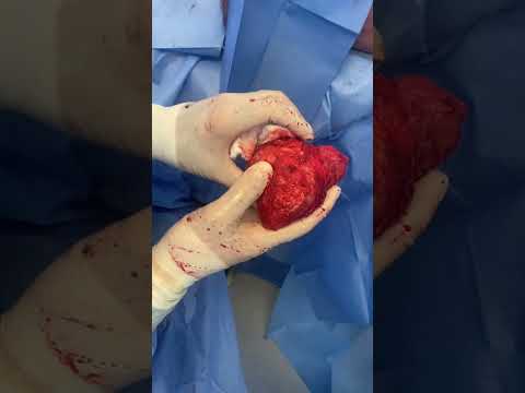 Grade 4 Capsular Contracture