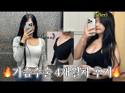 G컵 4개월차 후기🔥 | 당일~2주차, 불편한점, 가슴골지방이식, 촉감 [이수2Vlog]