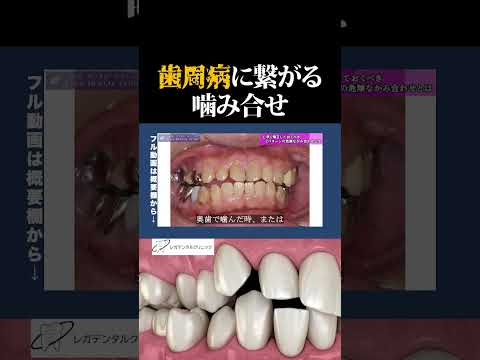 歯磨きだけでは解決しない歯周病の原因とは？（Part2）【歯科医師が語る】