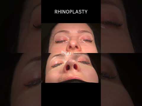 Patient Journey: Rhinoplasty Transformation 🌟