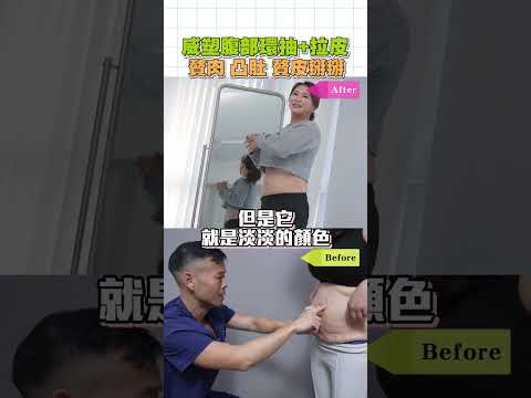 嘉義腹部拉皮改善腹部肥胖產後皮膚鬆弛問題 #嘉義腹部拉皮 #嘉義腹部抽脂 #腹部拉皮