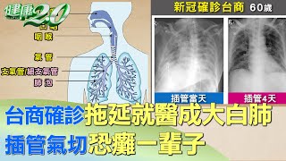 台商確診拖延就醫成大白肺 插管氣切恐癱一輩子 健康2.0