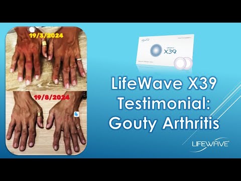 LifeWave X39 Testimonial: Gouty Arthritis By Mr Sin