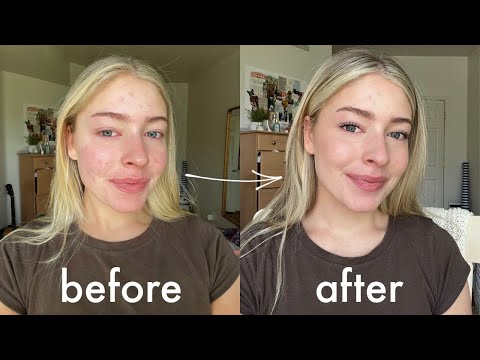 my everyday makeup routine with acne while on accutane!