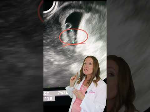 Can you HEAR the Heartbeat on a 7 Week Ultrasound?