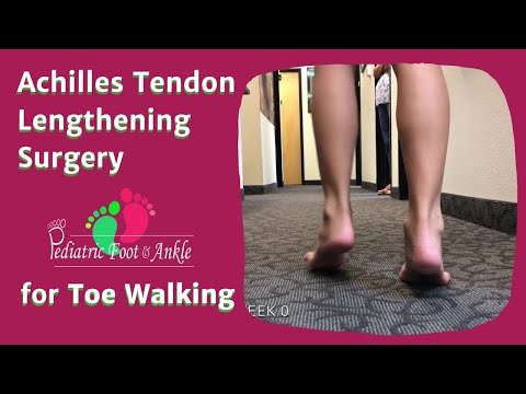 Achilles Tendon Lengthening Surgery for Toe Walking in 10 Year Old