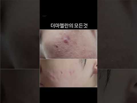 📢50대피부를 20대처럼🚫기미크림 이제 10개 남았습니다🚫#skincare #기미 #기미없애는법 #기미잡티 #기미제거 #기미관리