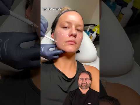 Face Lift Using Fillers! Surgeon Reacts