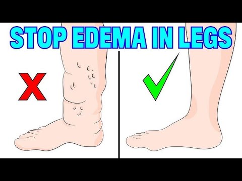 How to Treat Edema with Home Remedies That Actually Work | 5 Home Remedies for Edema