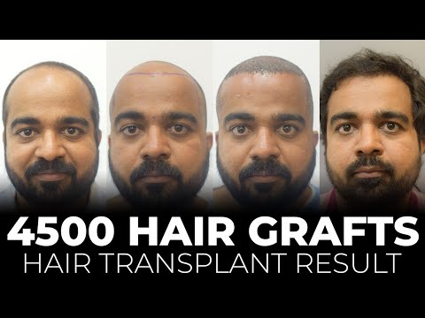 4500 Hair Grafts Transplant | Sapphire Hair Transplant Results