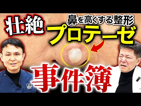 鼻プロテーゼの整形は将来的に皮膚から飛び出す可能性があります…！整形する前にリスクを理解してほしいです。#美容整形 #鼻プロテーゼ #プロテーゼ