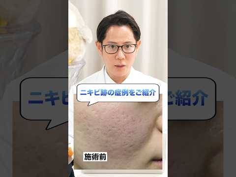 Japanese Dermatologist: Case Study Explanation of Acne Scar Treatments