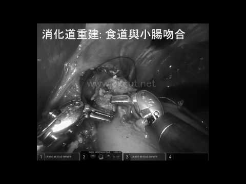 20170430 機器人胃癌全胃切除手術片段 ( 經黑白變色)