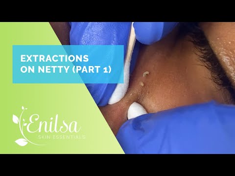 Blackheads... and more blackheads! Netty's First Treatment