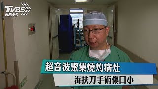 超音波聚集燒灼病灶　海扶刀手術傷口小