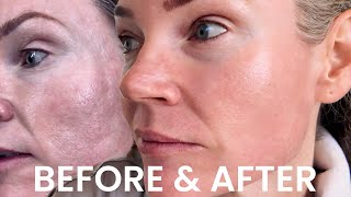 VBEAM Face LASER Treatment: 2 Weeks Before and After