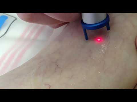 Laser Treatment of Vascular Lesion by MedArt VariMed System