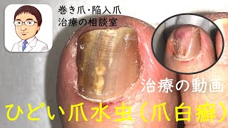 重症の爪水虫（白癬）治療　壊死した爪の除去：巻き爪・陥入爪治療の相談室　Treatment of tinea unguium ( Nail fungus)