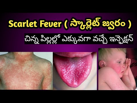 Scarlet Fever Symptoms and treatment in Telugu ( స్కార్లెట్ జ్వరం లక్షణాలు ,చికిత్స విధానం)