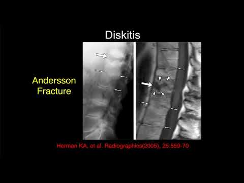 MRI of the Lumbar Spine | Part 7 - Lumbar Inflammation