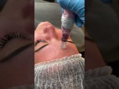 microneedleing