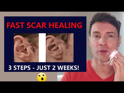 How I healed my scar in 14 days - 3 minute video with 3 steps.