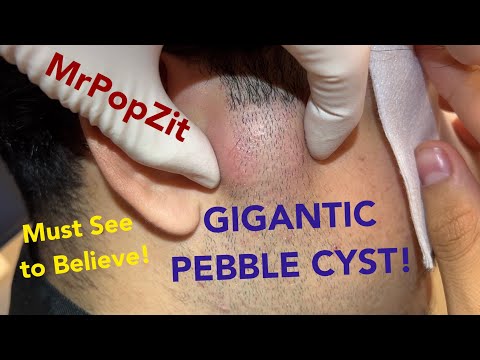 GIANT PEBBLE CYST in face.You haven’t seen one like this before! Perfect example of a Pilomatricoma