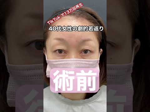 TikTok 13万再生の眉下リフトビフォーアフター！