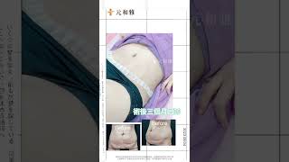 元和雅 #腹部拉皮 #腹腰環抽 #漂亮媽咪 - 術後三個月回診 小腹平坦看的見