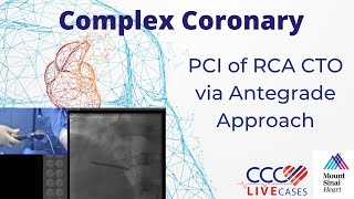 PCI of RCA CTO via Antegrade Approach - CCC Live May 2016