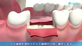 ３D動画で見るデンタルインプラント治療の流れ「インプラントを奥歯に一本埋め入み」