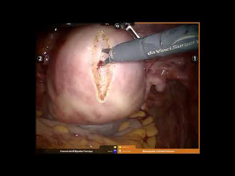 Robotic Myomectomy Dr Rooma Sinha Apollo Hyderabad India