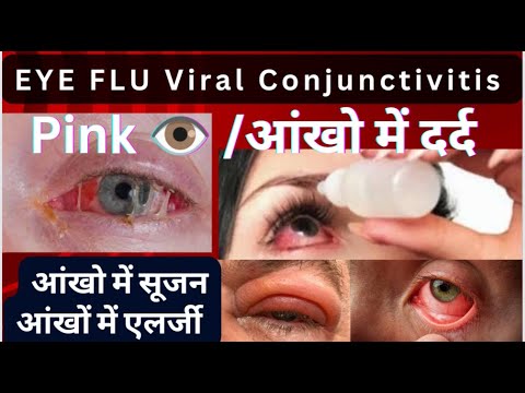 Eye Flu conjunctivitis || Eye Flu viral || आंख में इंफेक्शन की दवा,आँख में सूजन,आँख में दर्द#eyeflu