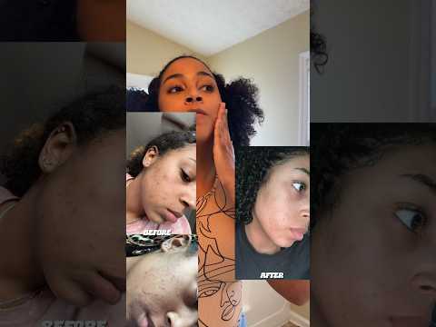 3 month acne update 🤍 #skincare #skincareroutine #dermatologist #kayyyvonne #dermatologistapproved