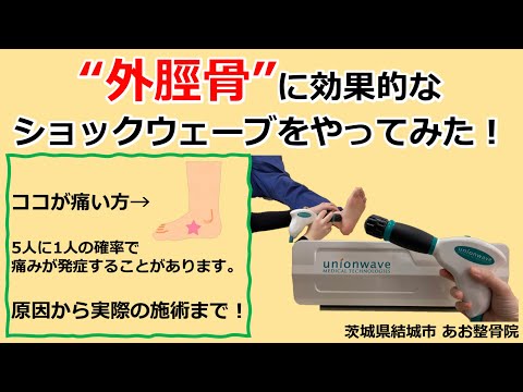 【ショックウェーブ】外脛骨に効果的なショックウェーブでの施術をお見せします👀｜茨城県結城市 あお整骨院