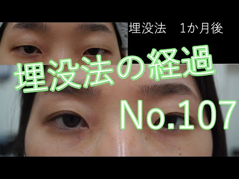 埋没法107　一重まぶたからナチュラルな感じの末広二重へ