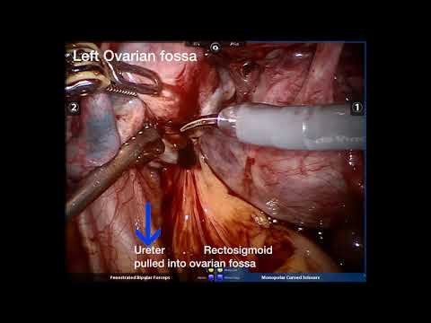 ENDOMETRIOSIS EXCISION using Robotic Surgery  Rooma Sinha Apollo Hyderabad