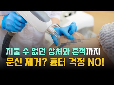 문신 제거하는 시술 통증이 심한 편인가요?│문신제거