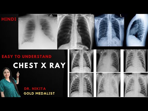 Chest X Ray, How to read X Ray बीमारी में कैसा दिखता हैं X-ray| X - ray कैसे देखते है, X Ray Reading