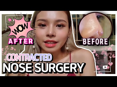 CONTRACTED NOSE REVISION RHINOPLASTY : KOREAN PLASTIC SURGERY VLOG PT.1