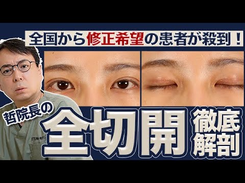 【全切開】生まれての二重みたい！全国から患者様が集まる雑誌にも取り上げられているこだわりの技術を医師が解説！