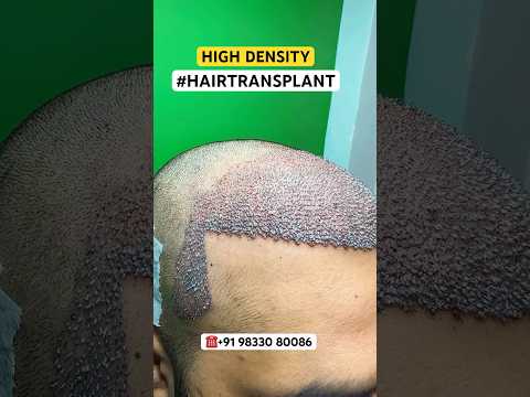 बालों का झड़ना , गंजा होना , बालों का पतला होना #hair #prp #hairtransplant #ytshorts #shorts #viral