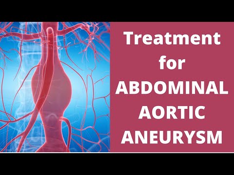 Treatment of Abdominal Aortic Aneurysms