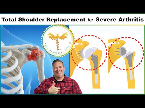 Doctor explains the Best Total Shoulder Replacement Procedures for Severe Arthritis